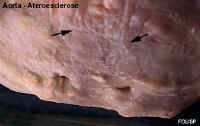 aortaatero3.jpg (24716 bytes)