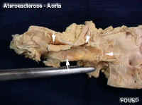 aortacalc2.jpg (30768 bytes)