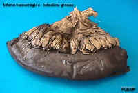 intestinfarthemor1.jpg (44300 bytes)