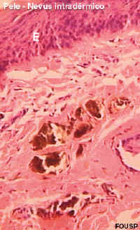 nevus.jpg (49216 bytes)